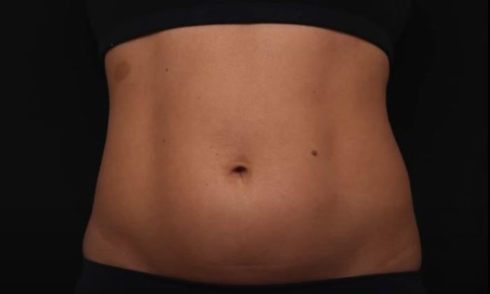 Friolip – Before/After 1