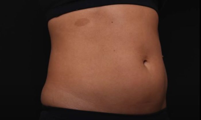Friolip – Before/After 2