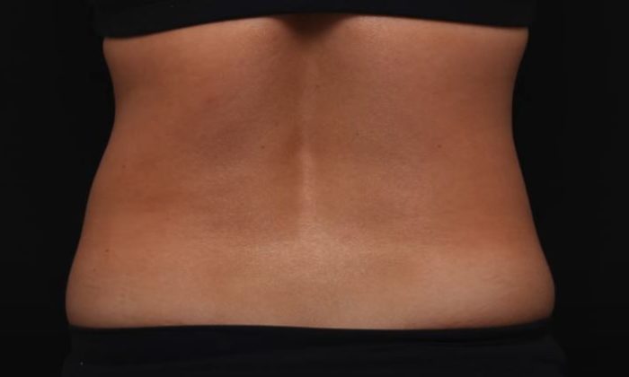 Friolip – Before/After 3